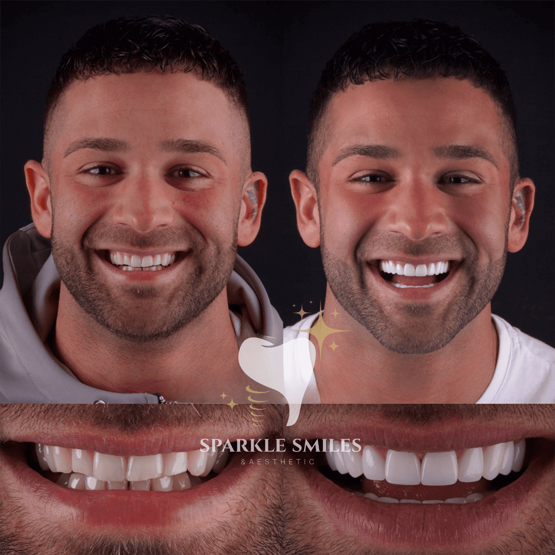 {t('treatments.zirconiumCrowns.title')}