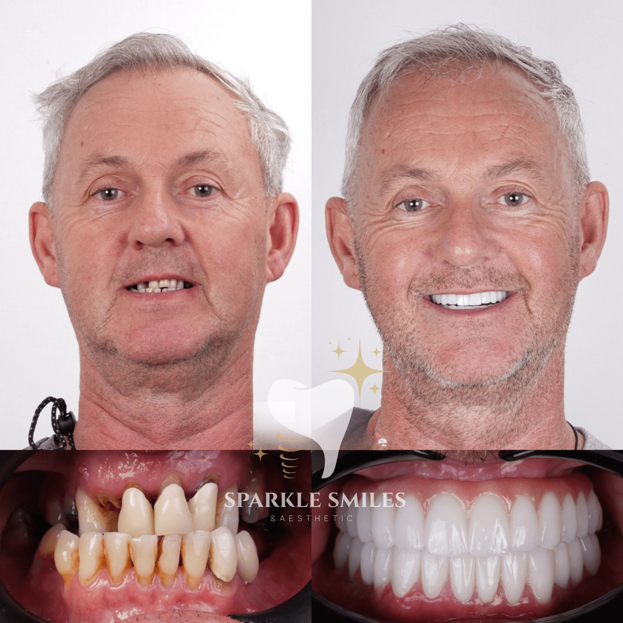 Dental Implant