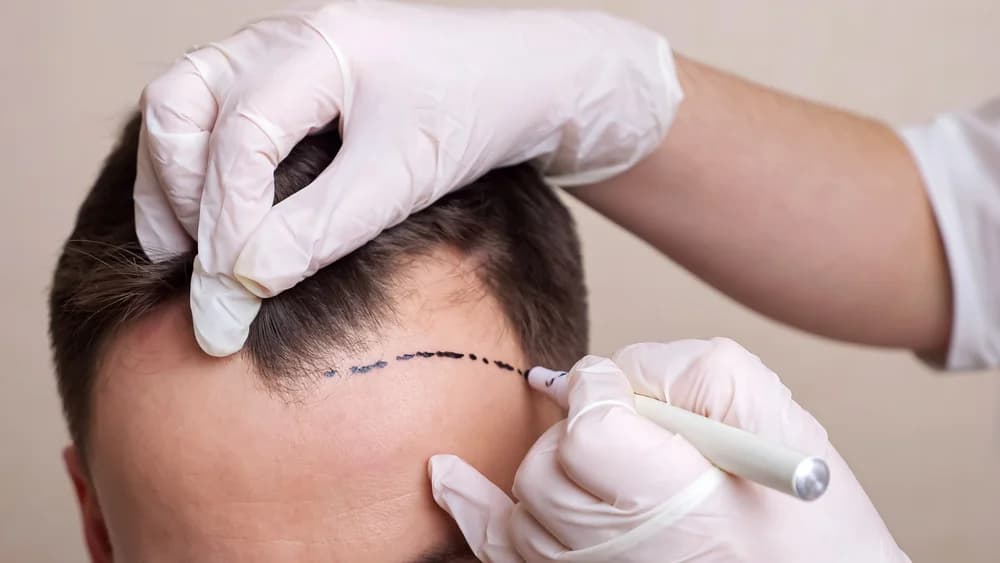 aesthetic.hairTransplant.title