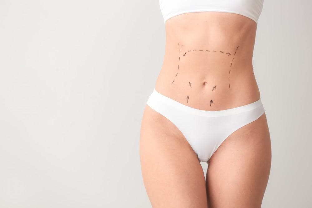 Liposuction