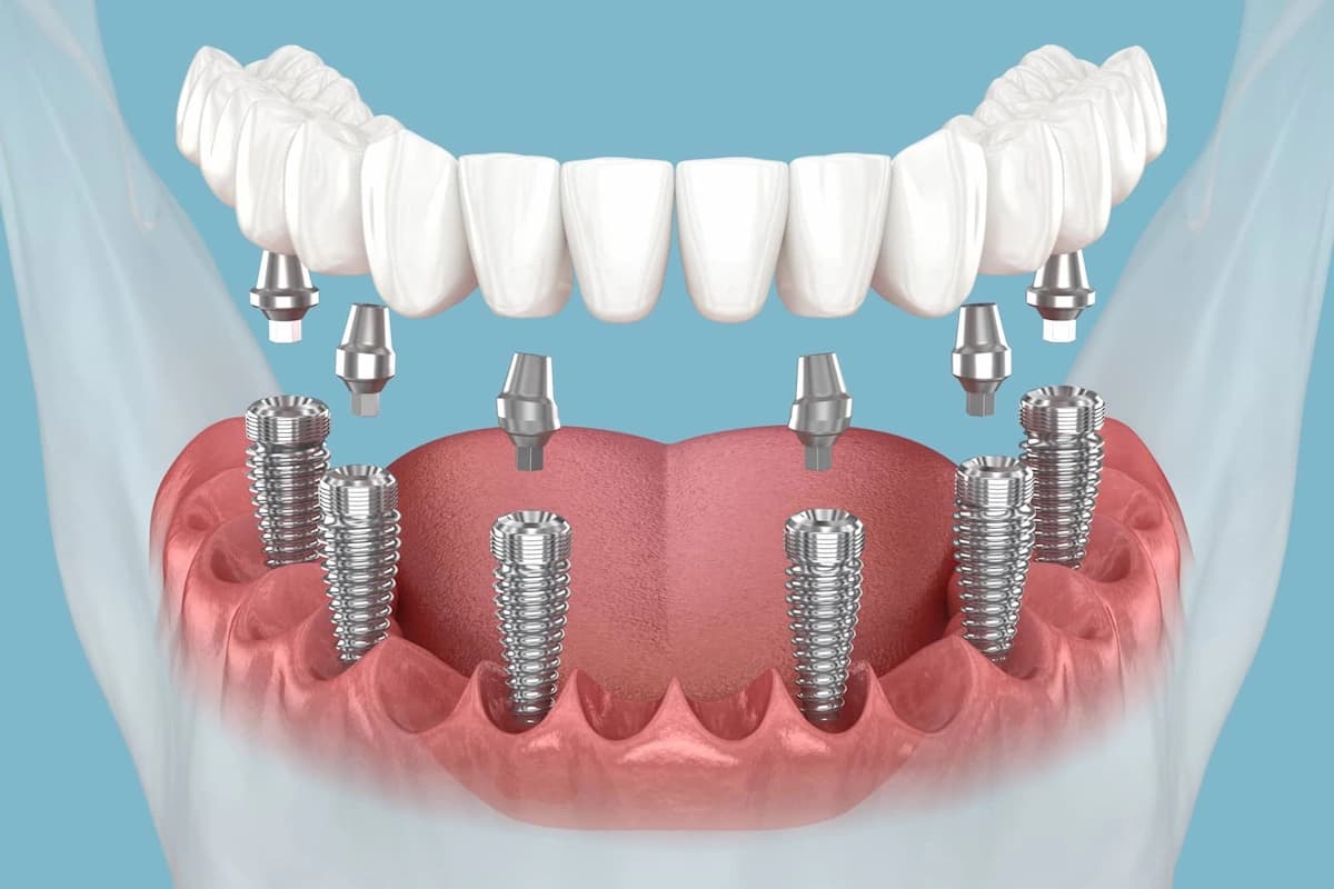 All-on-6 Treatment