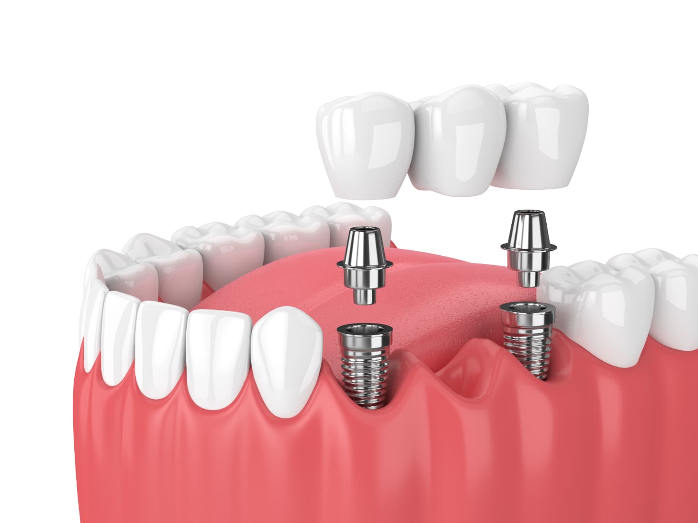 Dental Implant
